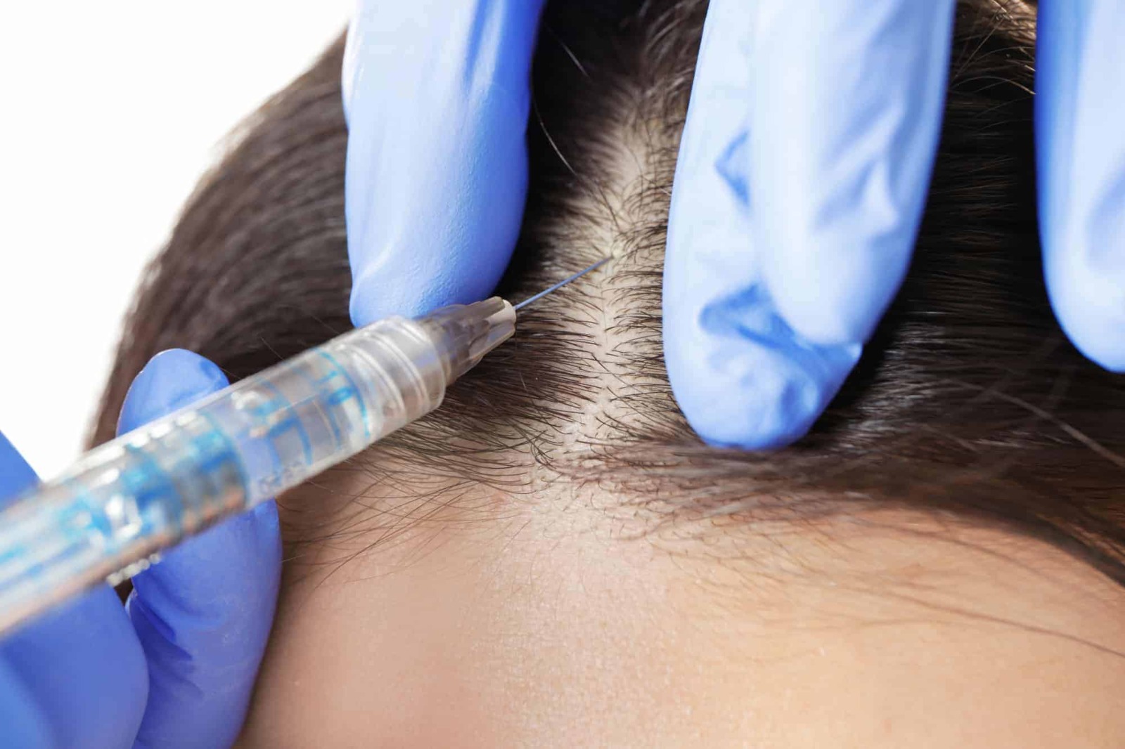 Transform Your Look with a Hair Transplant at Westminster Medical Group