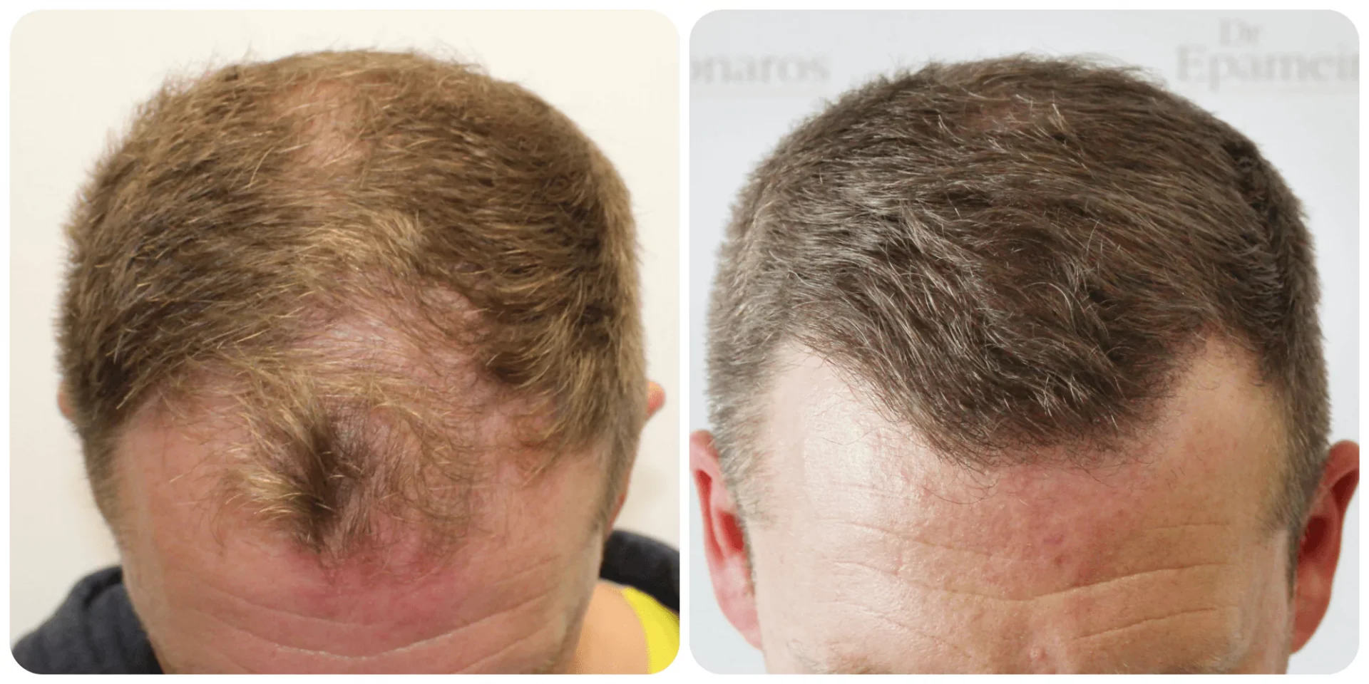 Hair Transplant UK – Expert Care for Men and Women Alike