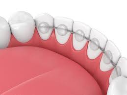 Ceramic Braces vs Metal Braces: Which Is Better for You?